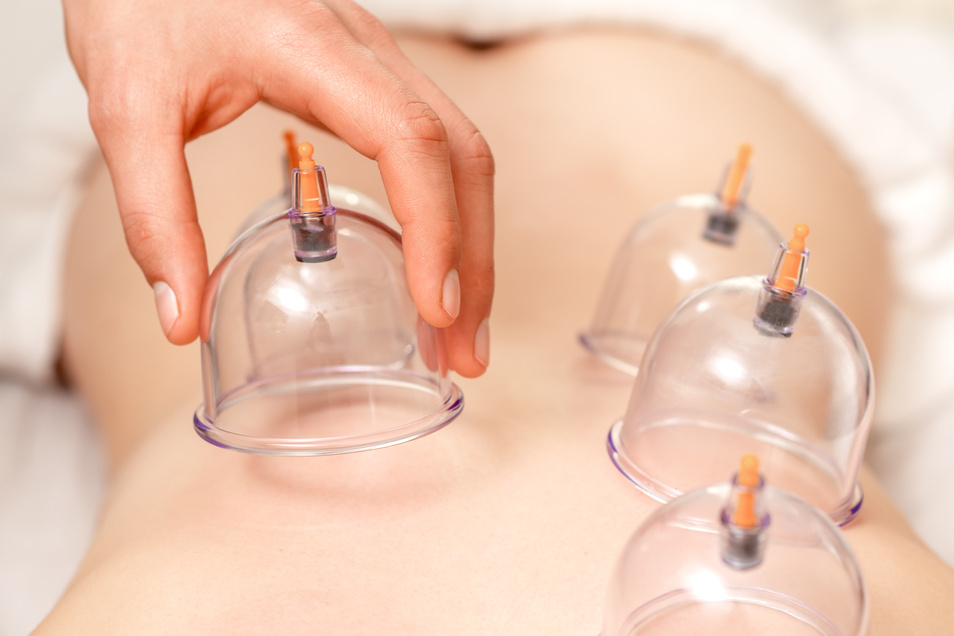 Vacuum cups of medical cupping therapy on woman back.